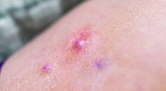 hidradenitis suppurativa