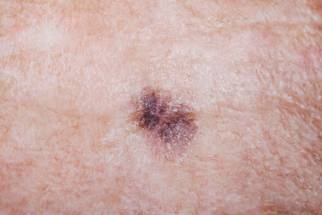skin cancer melanoma