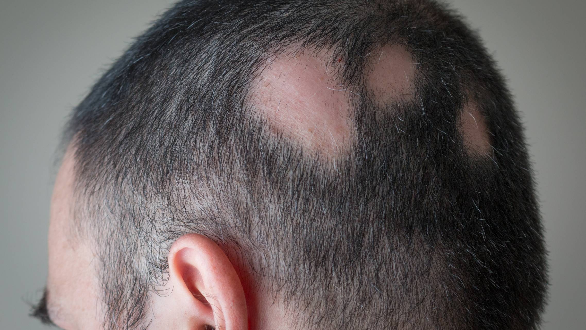 JAK Inhibitors Make the Cut for Alopecia Areata
