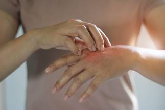 Lillys Lebrikizumab Improves AD on Face Hands image