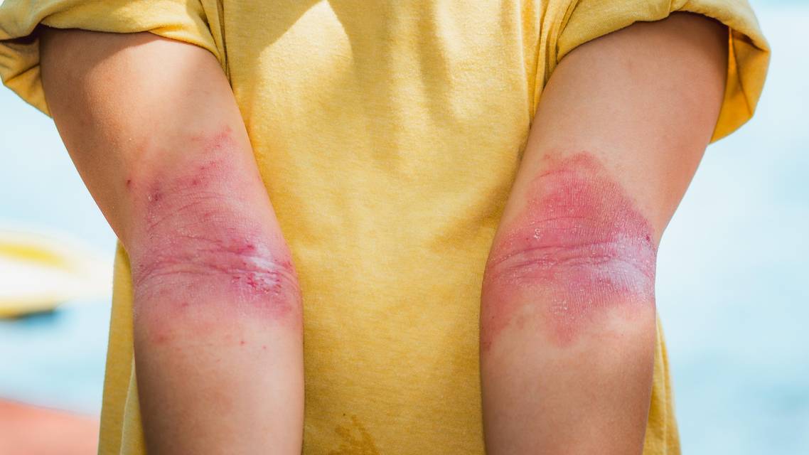 atopic dermatitis topical treatment