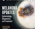 melanoma