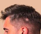 alopecia