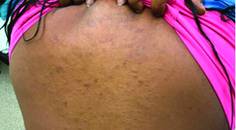 Granuloma Annulare