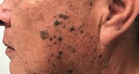 New Options for the Treatment of Extensive Seborrheic Keratosis image