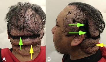 Case Study Highlights Possible Role for Minimal Dose Radiotherapy in Severe Acne Keloidalis Nuchae image
