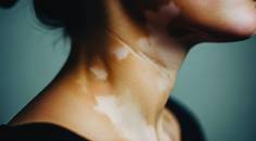 vitiligo