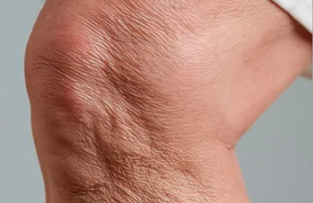 Knee skin
