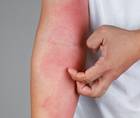 atopic dermatitis