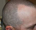 melasma