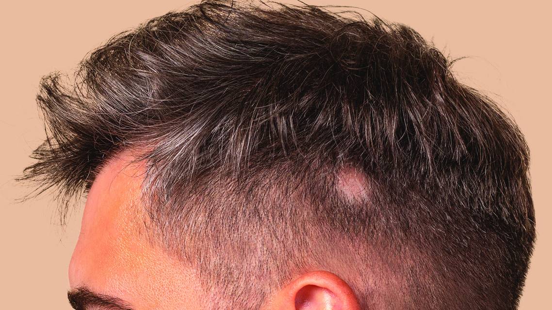 alopecia