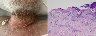 When Lightning Strikes A Case Study of Staphylococcal Scalded Skin Syndrome in a 55yearold Man image