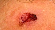 Cutaneous Signet Ring Squamous Cell Carcinoma Case Presentation and Brief Literature Review