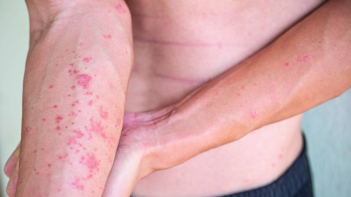 atopic derm
