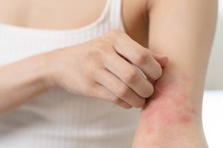 rash reduction