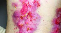 Epidermolysis Bullosa