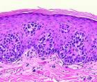 SKIN CANCER