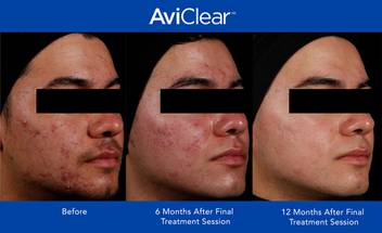 One Year Data Cuteras AviClear Comtinues to Improves Acne image