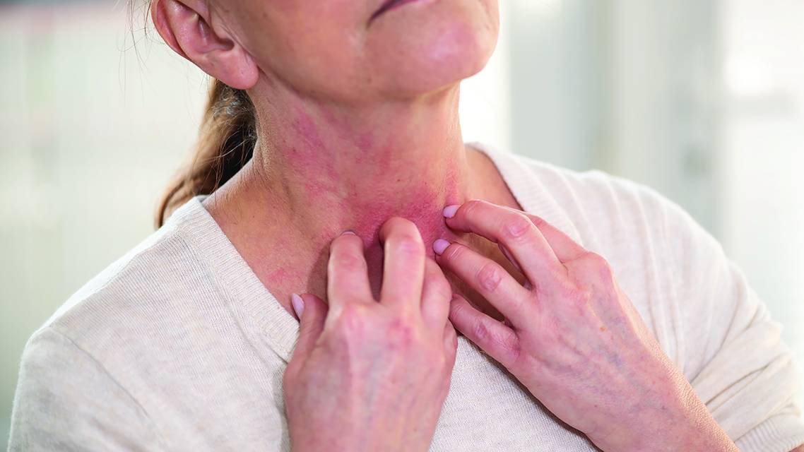 atopic dermatitis