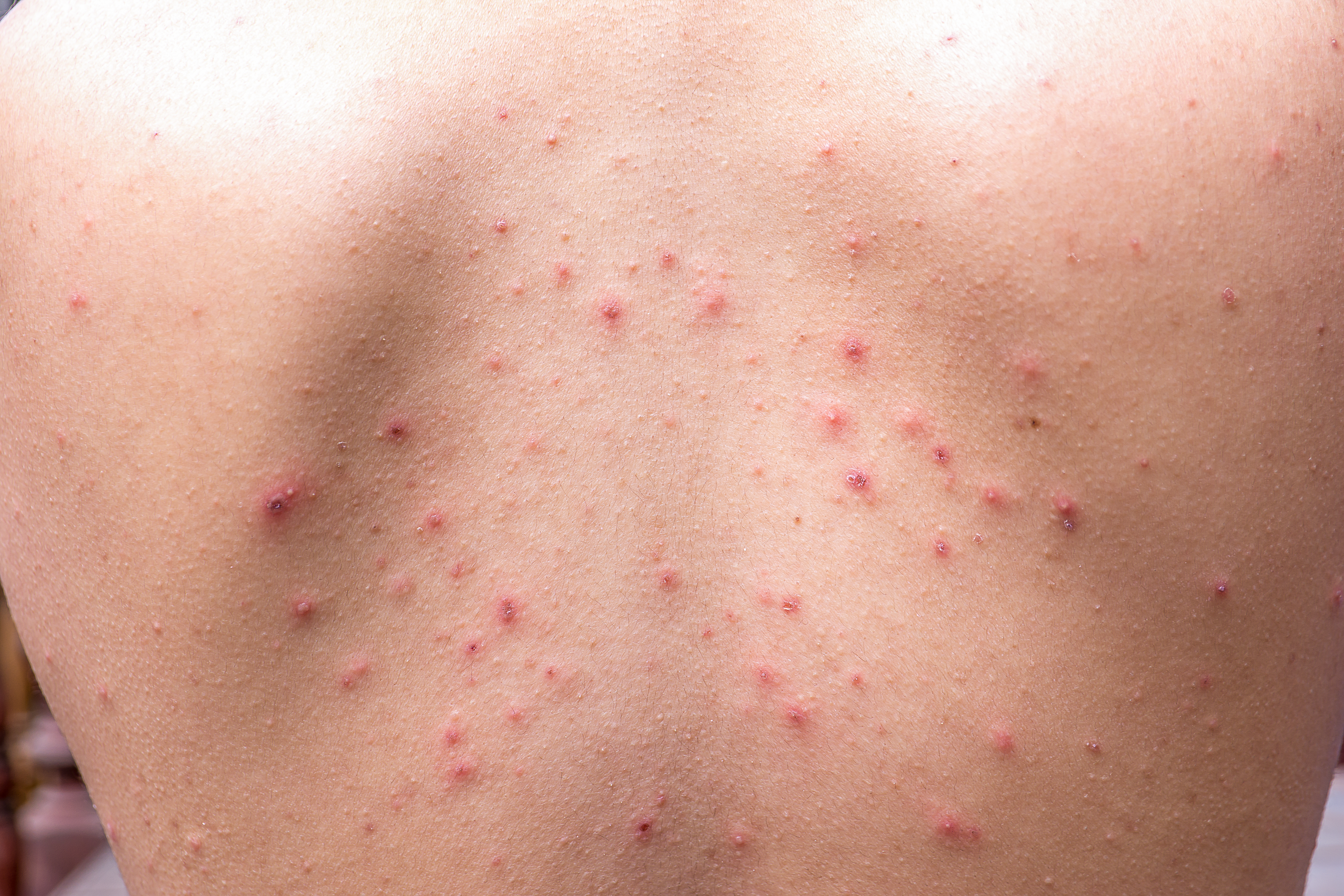 Online Extra: Let's Talk About Truncal Acne - - PracticalDermatology, image size:6000x4000