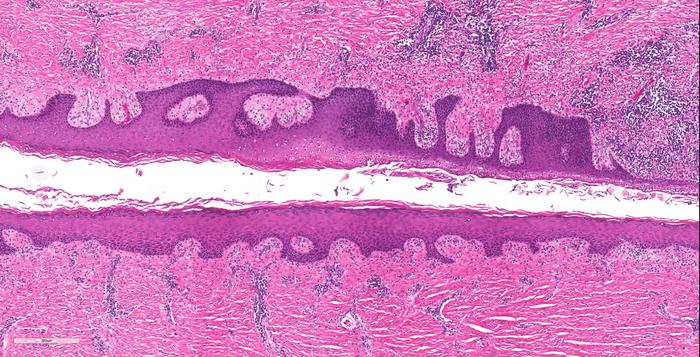 Research Closes in on the Genetic Factors Underlying HS Risk ...