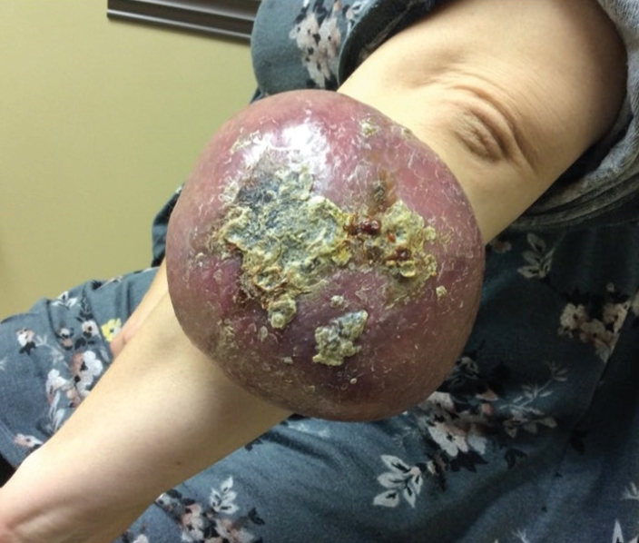 Figure 1. Patient at initial presentation to dermatology office. 27x21.5cm firm non-pulsatile erythematous tumor with overlying crust located on the left ulnar forearm.
