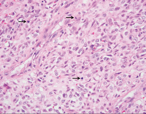 Figure 3. 400x. Fusiform tumor cells have vesicular chromatin and pale eosinophilic cytoplasm. Mitotic figures are apparent (arrows).