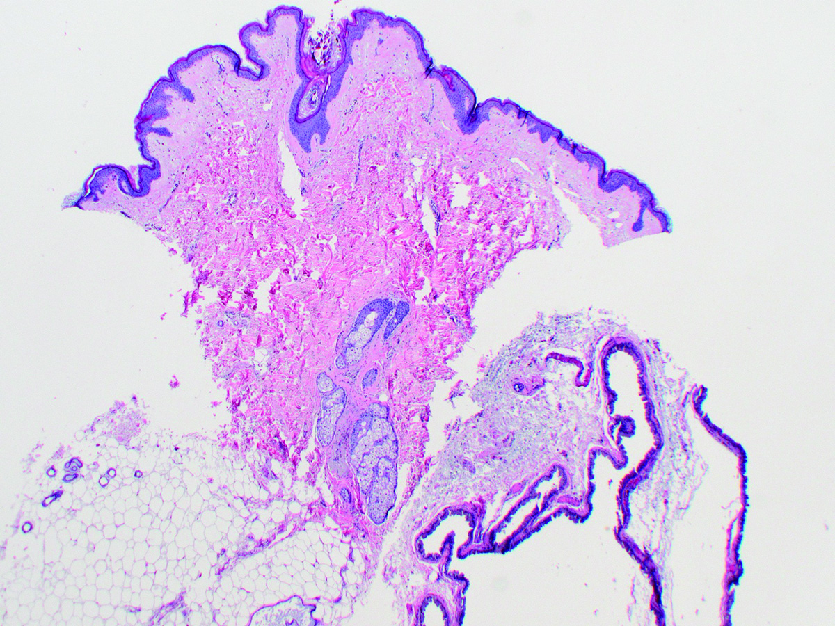 Apocrine Hidrocystoma of the Axilla - PracticalDermatology
