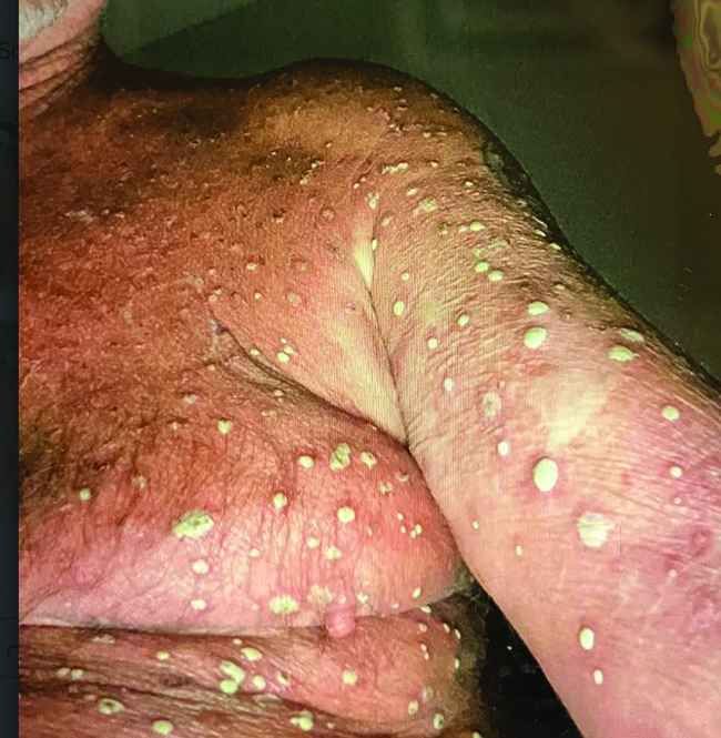 Case Study: Recurrent Generalized Pustular Psoriasis - PracticalDermatology